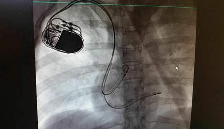 业务动态心内科成功完成一例抗核磁心脏起搏器植入术