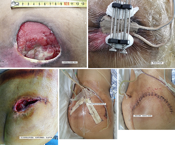 巨大褥疮的治疗5手术结合假肢/矫形器治疗先天性畸形4